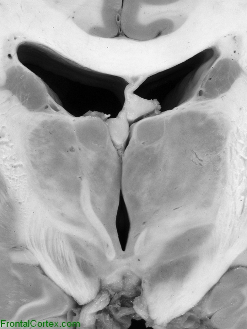 Thalamus Coronal Close Up